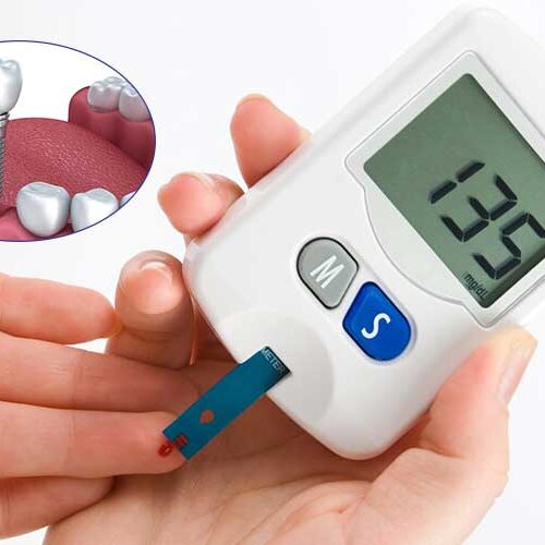 Implant dentar la diabetici: conditii si riscuri Implant dentar la diabetici: conditii si riscuri
