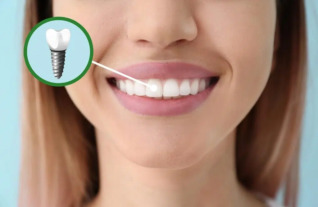 Persoanele sub 18 ani nu pot beneficia de implanturi dentare Persoanele sub 18 ani nu pot beneficia de implanturi dentare