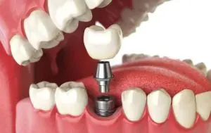implantul dentar