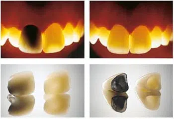Coroana metalo-ceramica vs coroana ceramica pe suport de zirconiu Coroana metalo-ceramica vs coroana ceramica pe suport de zirconiu