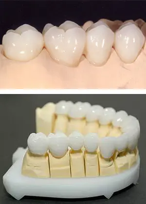 Coroana dentara ceramica pe suport de zirconiu Coroana dentara ceramica pe suport de zirconiu