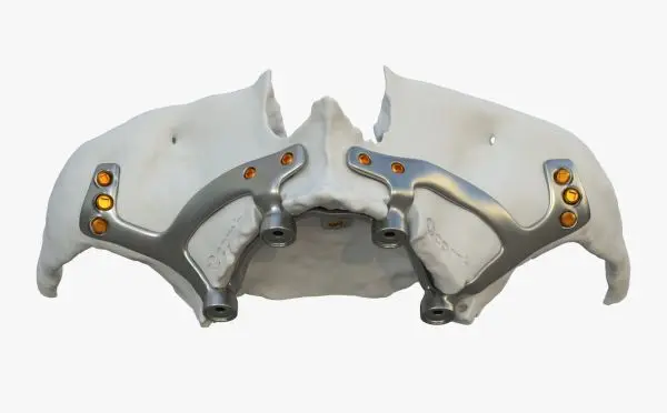 Implant subperiostal la maxilar implant dentar subperiostal schelet titan