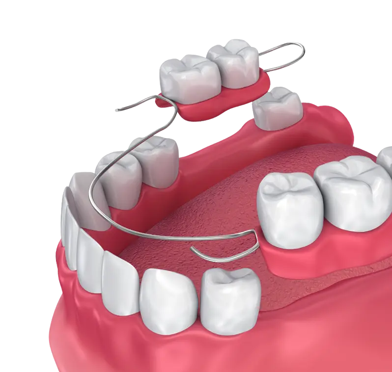 proteza-dentara-scheletata proteza dentara scheletata