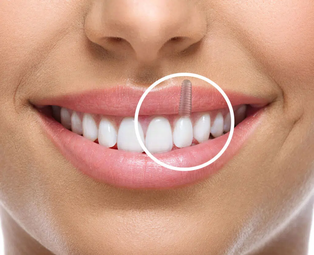 Implant dentar pentru incisiv lateral Implant dentar pentru incisiv lateral