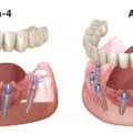 Lucrare fixa pe 4 si 6 implanturi Fast Smile Inno