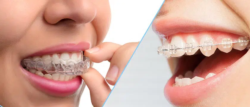 indreptarea dintilor fara aparat dentar