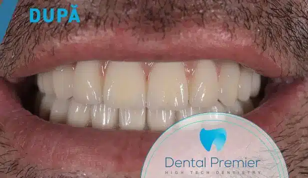 Dupa de tratamentul cu implanturi dentare si coroane ceramice