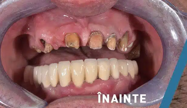 Inainte de tratamentul cu implanturi dentare si coroane ceramice