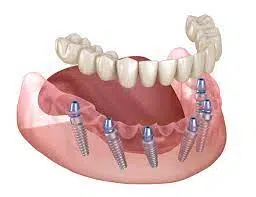 full-mouth-rehabilitation-dental-implants Full mouth rehabilitation with same day dental implants
