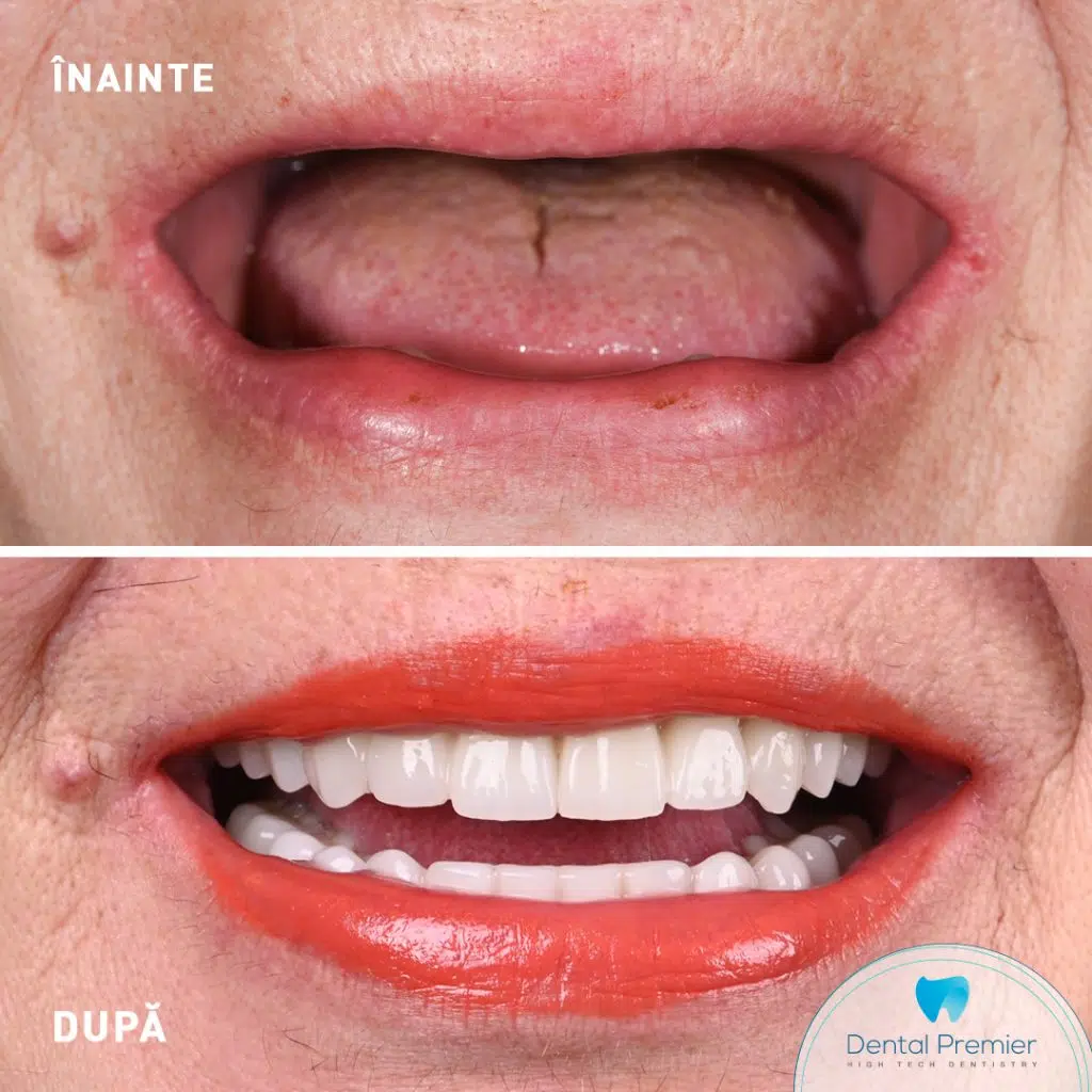 Dinti ficsi in 24 de ore cu proteze fixe pe implanturi All-on-4 si All-on-6 - Maxilar si mandibula
