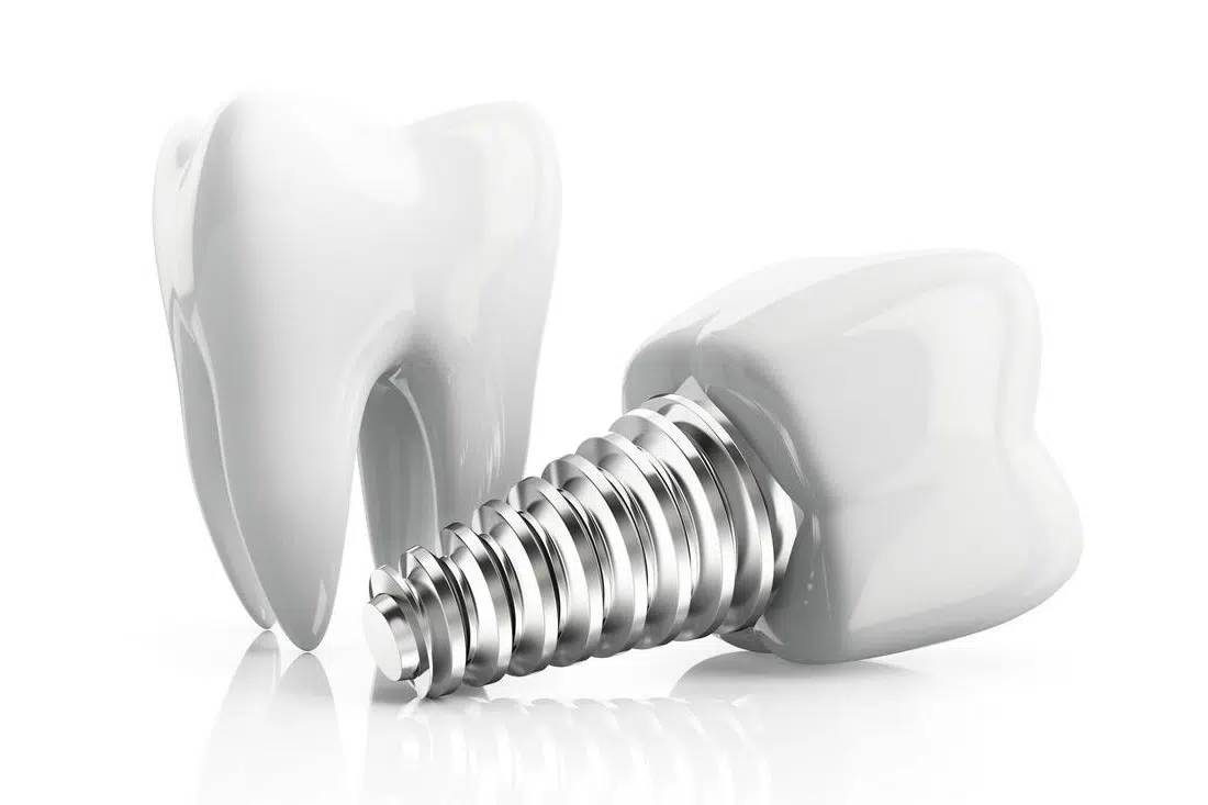 Implant dentar