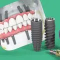 Straumann PRO Arch® Dental Implants System