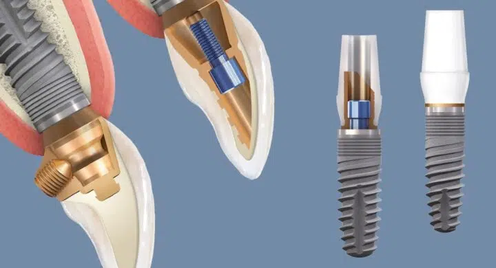 Implant dentar Bredent Blue Sky