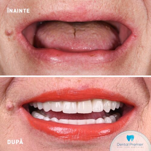 Proteze fixe cu 4 si 6 implanturi dentare Nobel Biocare Proteze fixe cu 4 si 6 implanturi dentare All-on-4 si All-on-6 Nobel Biocare