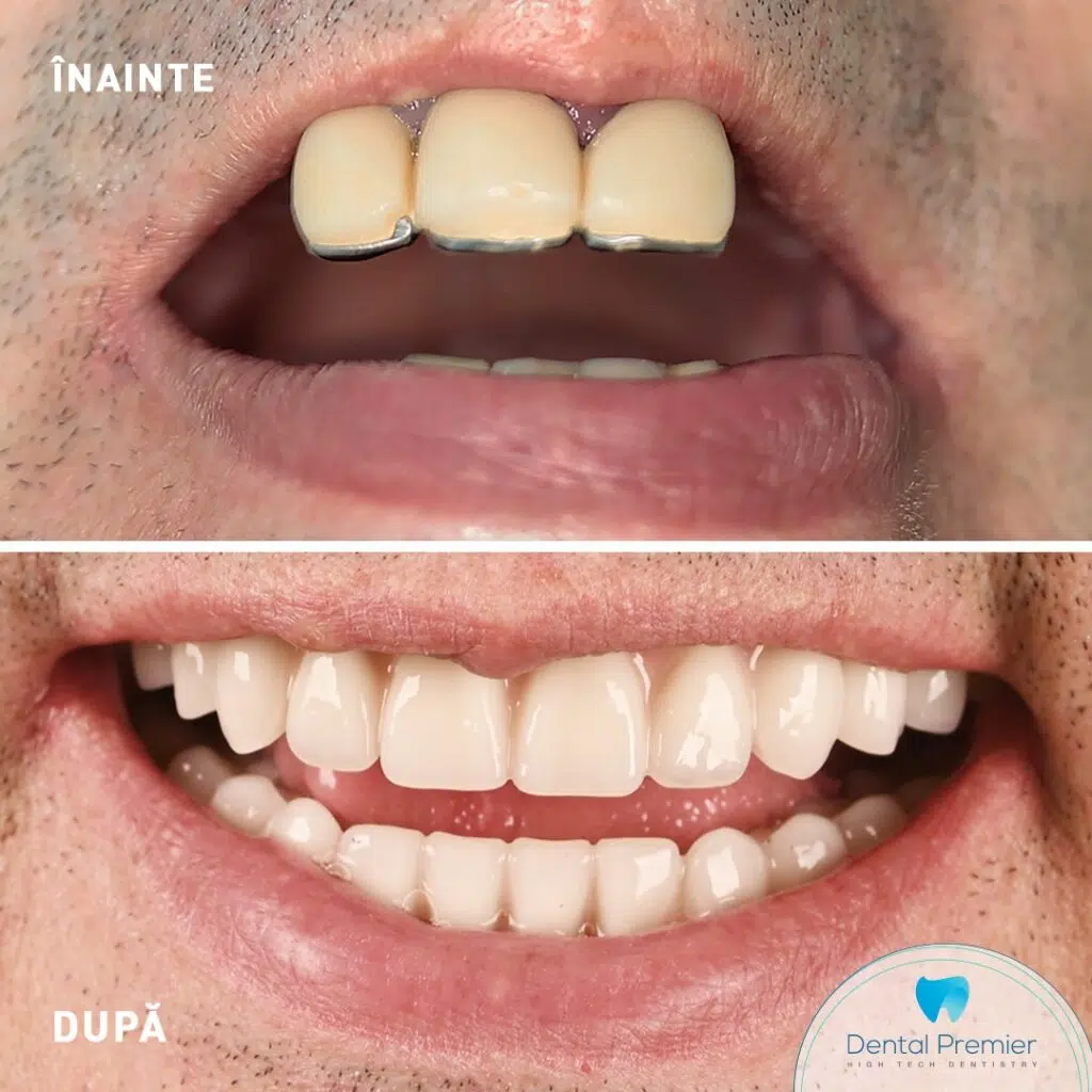 Pacient 57 de ani - Implant subperiostal maxilar + Implant All-on-4 mandibula Pacient 57 de ani - Implant subperiostal maxilar + Implant All-on-4 mandibula