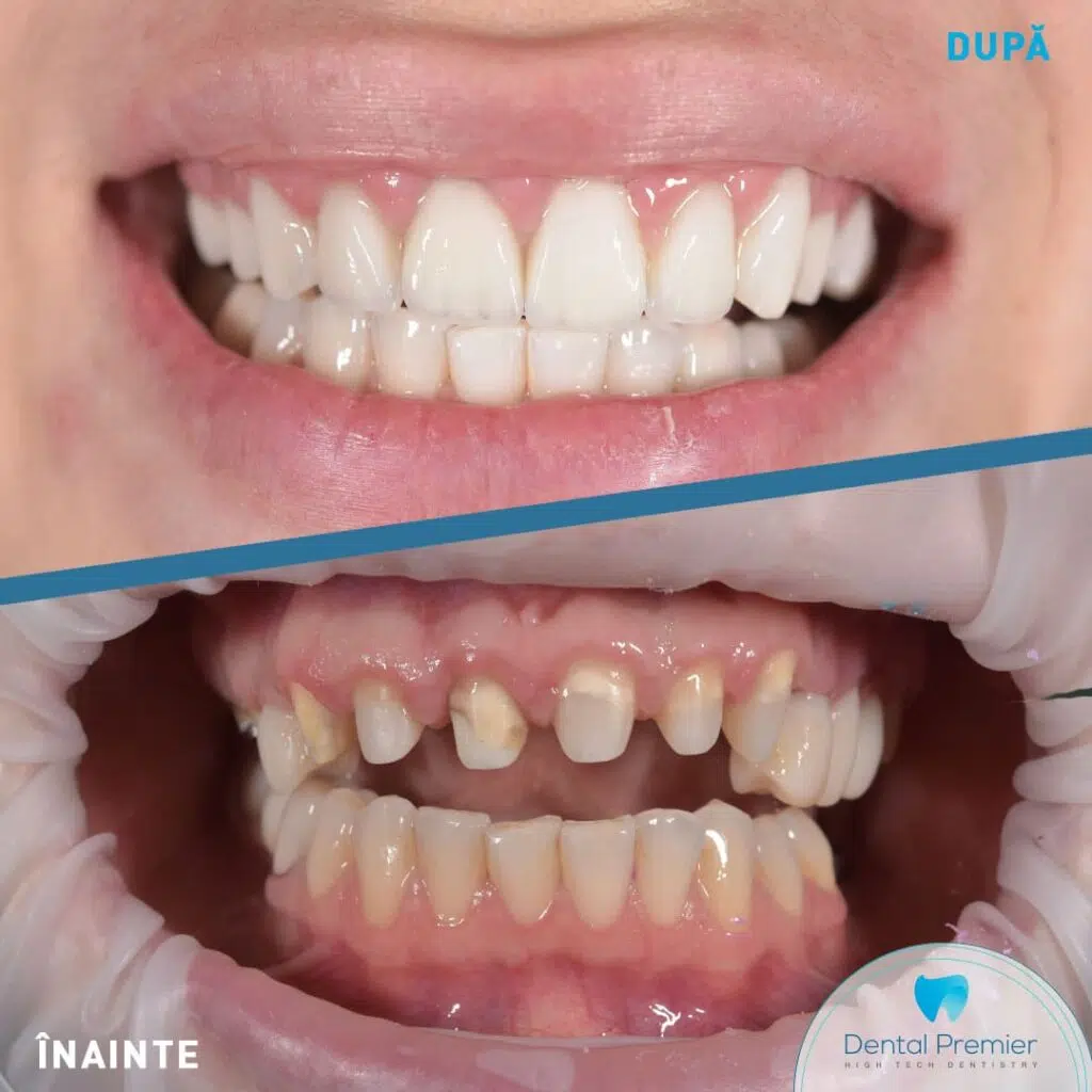 Dinti imbracati cu coroane ceramice pe zirconiu Dinti imbracati cu coroane ceramice pe zirconiu
