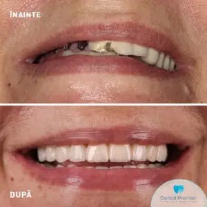 Fast&Fixed - proteza fixa cu 4 implanturi mandibula + implanturi Bredent maxilar Fast&Fixed - proteza fixa cu 4 implanturi mandibula + implanturi Bredent maxilar