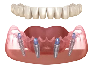 Proteza dentara fixa cu 4 implanturi All-on-4 Proteza dentara fixa cu 4 implanturi All-on-4