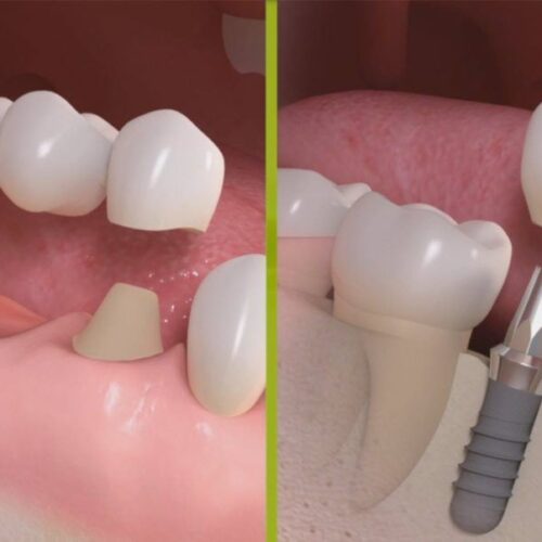 Reconstructie dinte lipsa cu implant versus punte dentara Reconstructie dinte lipsa cu implant versus punte dentara