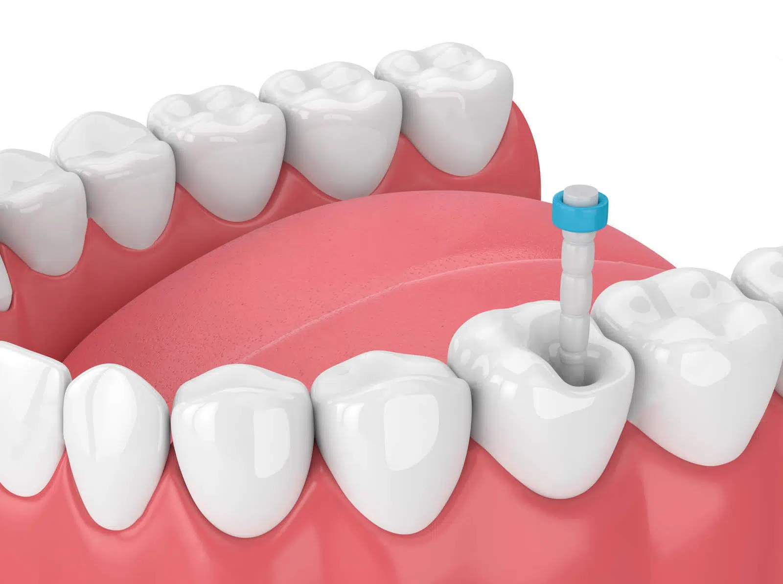 Reconstructie dinte cu pivot dentar si coroana