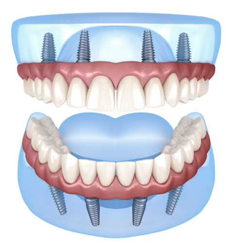 Maxillary and Mandibular prosthesis with gum All on 4 system supported by implants. Medically accurate 3D illustration of human teeth and dentures Proteza dentara pe 4 implanturi la ambele arcade dentare
