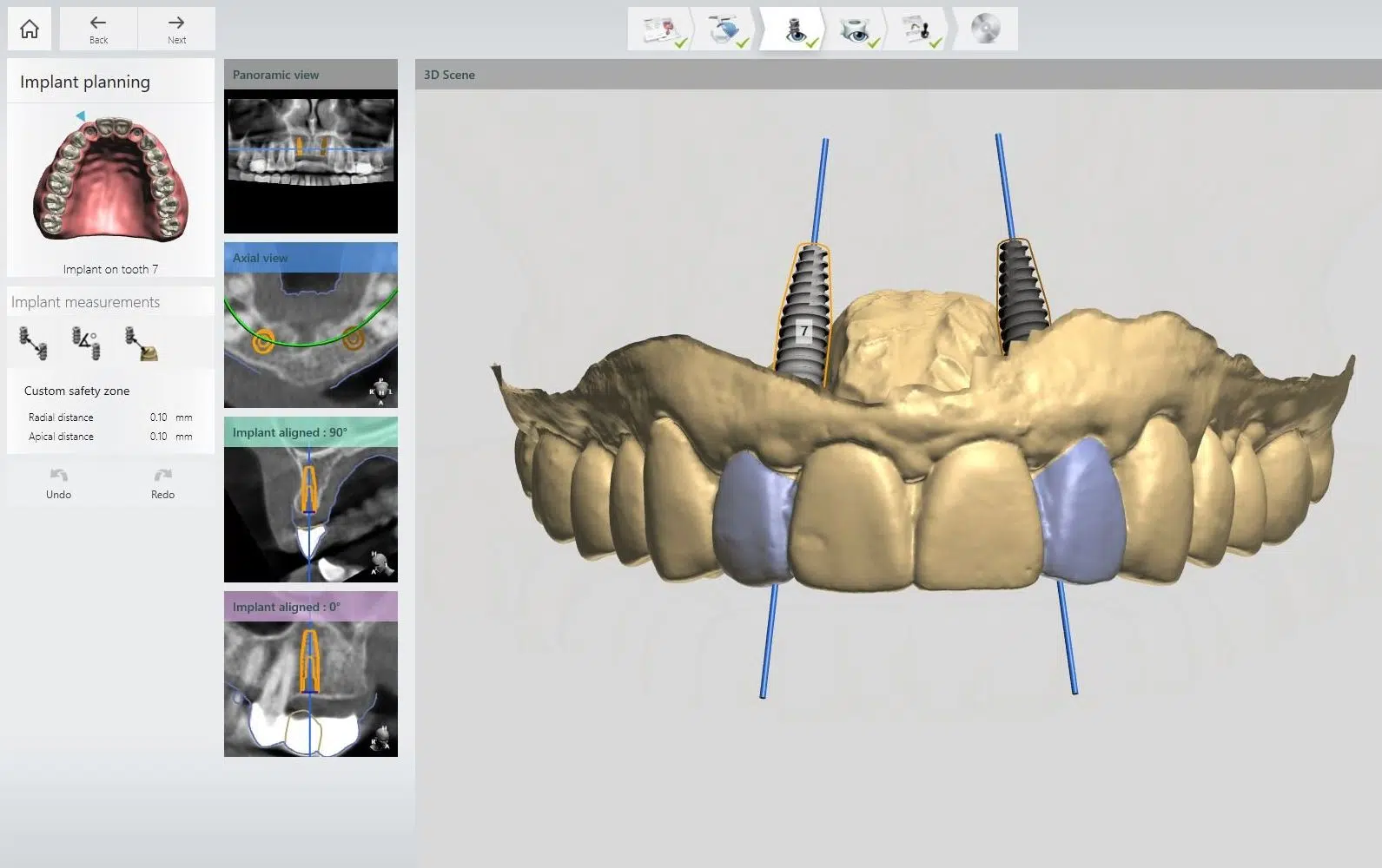 Planificarea digitala a implanturilor dentare