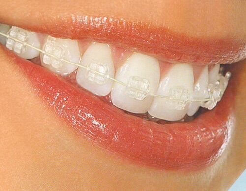Aparat dentar transparent cu bracketi din safir Aparat dentar transparent cu bracketi din safir