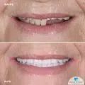 Proteze fixe cu 4 si 6 implanturi dentare Fast and Fixed