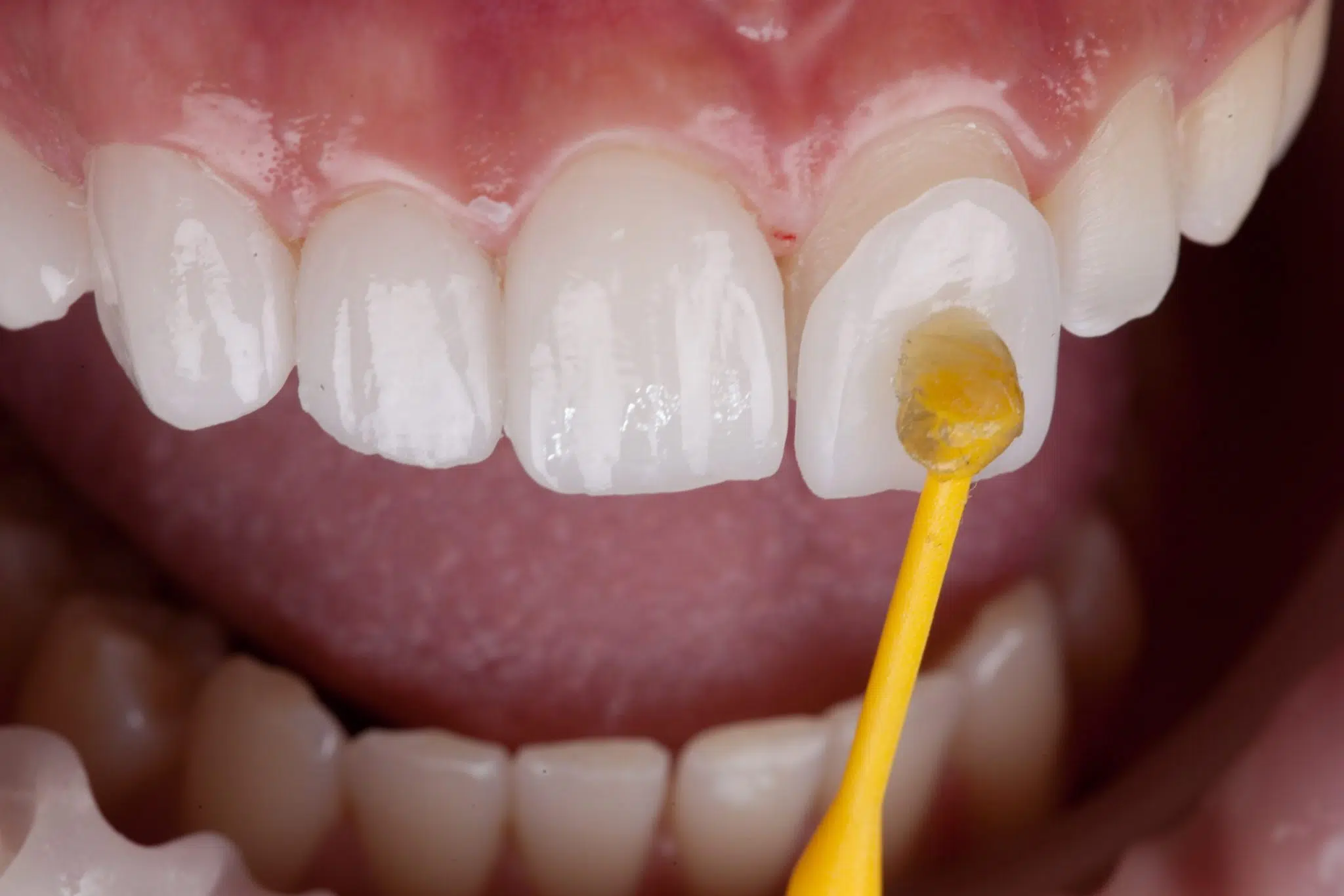 Fatete dentare ceramice Emax Fatete dentare ceramice Emax