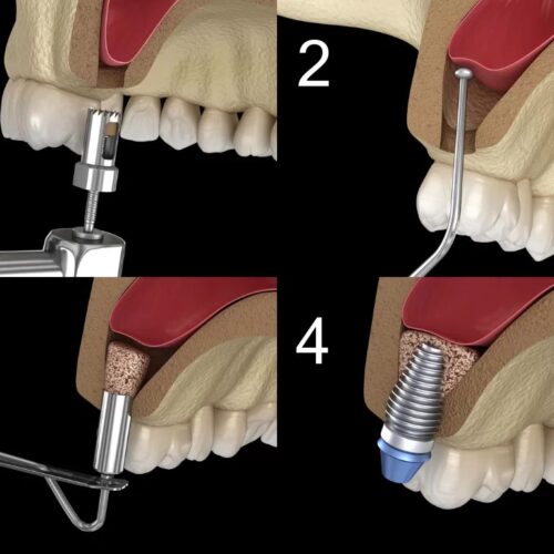 Sinus lift si augmentare osoasa la maxilar intr-o sedinta