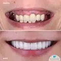 full mouth denture implants rehabilitation with All-on-6 dental implants cost