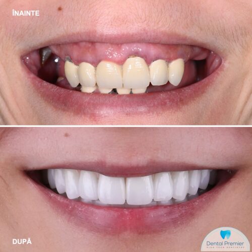 full mouth denture implants rehabilitation with All-on-6 dental implants full mouth denture implants rehabilitation with All-on-6 dental implants cost