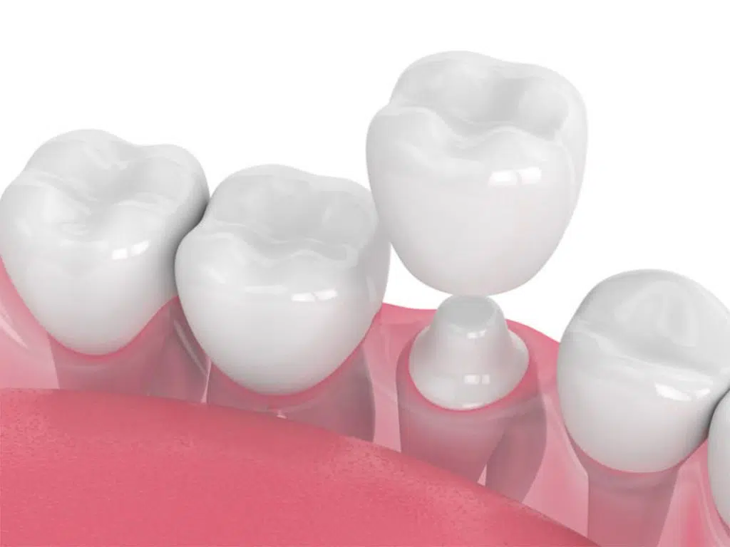 Coroana dentara pe dinte existent