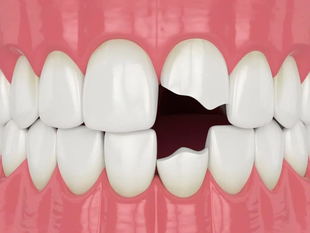 Coroane dentare rupte