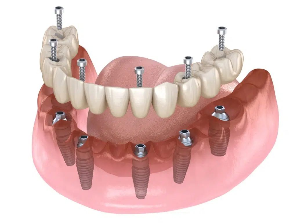Dinti ficsi in 24 ore cu lucrare fixa cu 6 implanturi Megagen All-on-6 la mandibula
