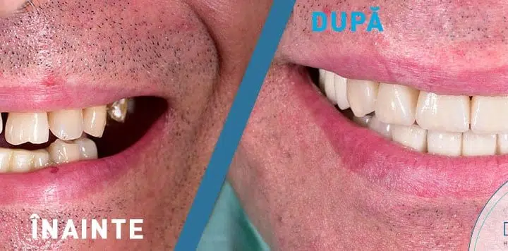 Pret fatete dentare toata gura