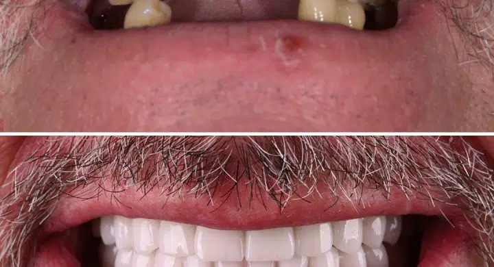 All-on-4 & All-on-6 - proteze dentare fixe cu 4 si 6 implanturi