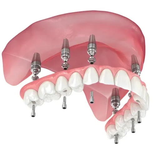 All-on-6- Proteza dentara fixa cu 6 implanturi la maxilar All-on-6- Proteza dentara fixa cu 6 implanturi la maxilar