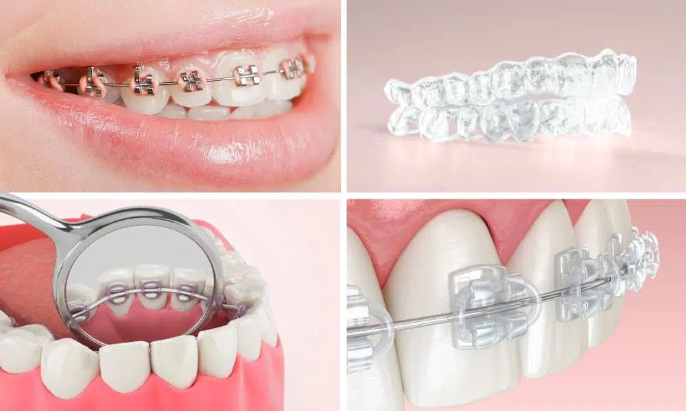 Tipuri de aparate dentare: fixe, mobile, invizibile