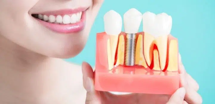 Mituri implanturi dentare