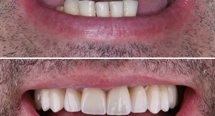 Coroane pe implanturi dentare Megagen