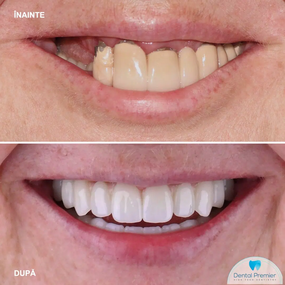 inti ficsi in 24 ore - Proteze Fixe pe 6 Implanturi - All-on-6 Megagen