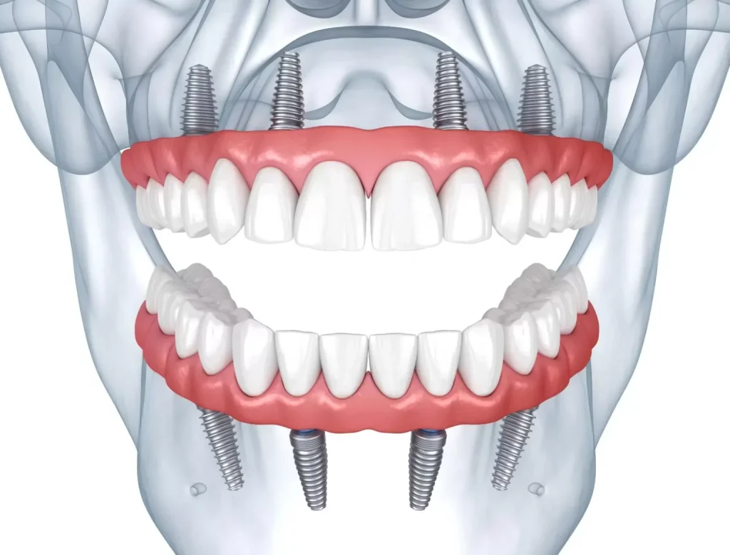 Restaurare completa a danturii cu All on 4 Straumann Pro Arch bimaxilar Restaurare completa a danturii cu All on 4 Straumann Pro Arch bimaxilar