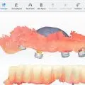 Amprenta digitala prin Scanare 3D intraorala IPG (fotogrametrie)