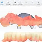 Amprenta digitala prin Scanare 3D intraorala IPG (fotogrametrie)