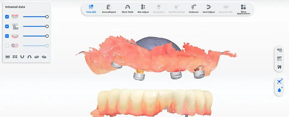 Amprenta digitala prin Scanare 3D intraorala IPG (fotogrametrie)