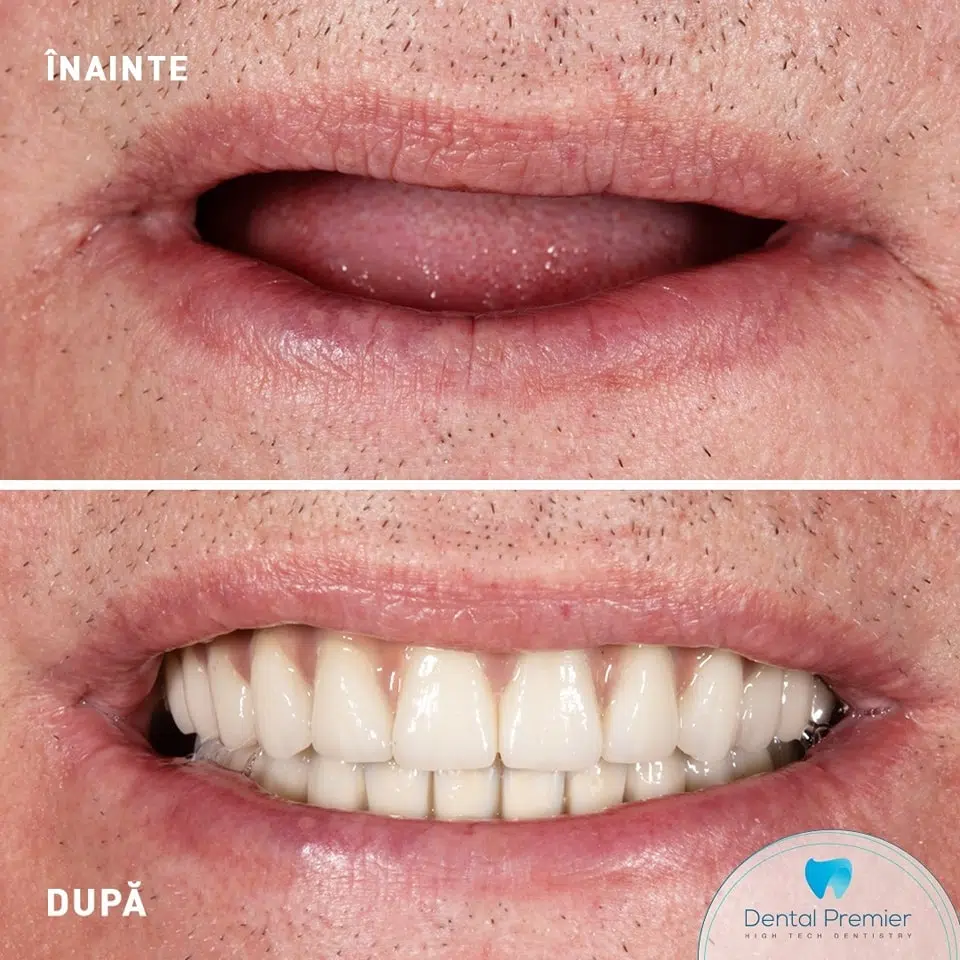 Proteze dentare fixe de ultima generatie cu 4 si 6 implanturi