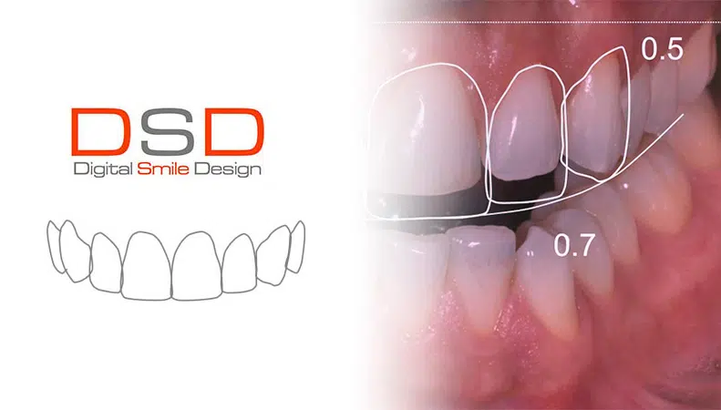 DSD Digital Smile Design Bucuresti Pret