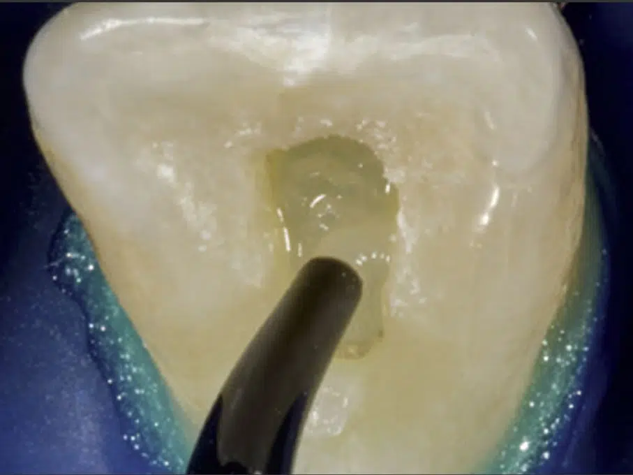 Albire dentara endodontica