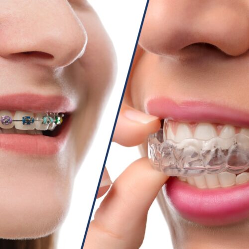 Aparat dentar metalic versus invizibil cu gutiere dentare pentru indreptat dintii Aparat dentar metalic versus invizibil cu gutiere dentare pentru indreptat dintii